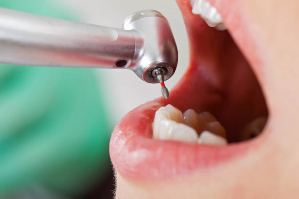 Best Emergency Tooth Extraction in Cherryland, CA